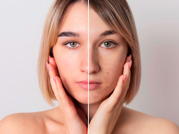 antes y despues tratamiento acne