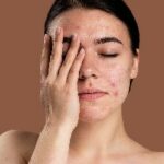 Mujer con dermatitis en el rostro se tapa el ojo derecho